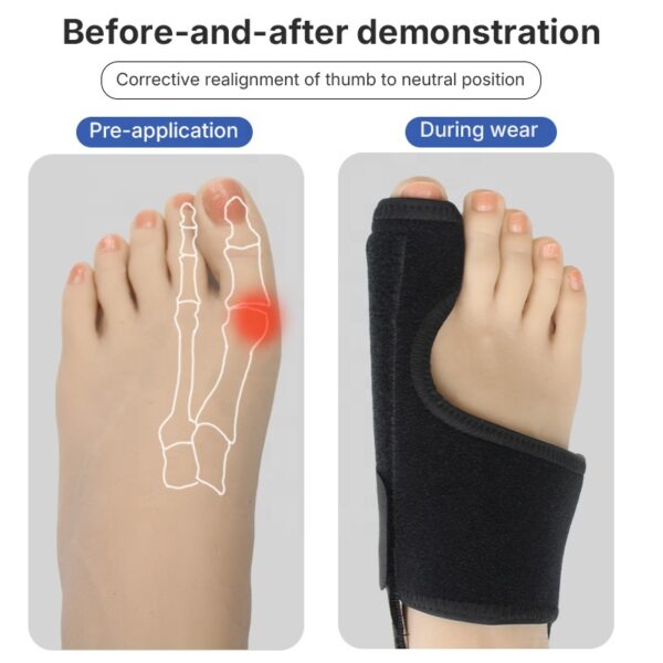 photobank (120) Adjustable Orthotic Correction Hallux Valgus Splint Separator Bunion Corrector Big Toe Separator