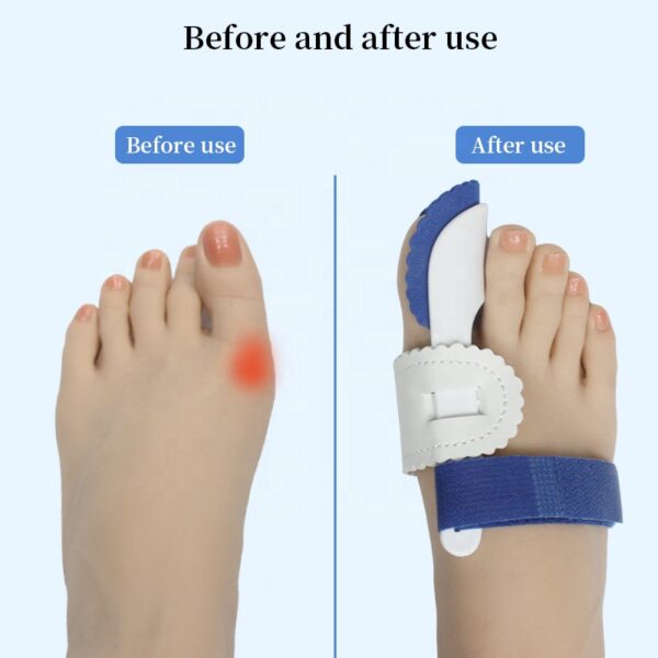 Men and Women Adjustabletoe Splint Bunion Band Hallux Valgus Bunion Corrector Big Toe Separator