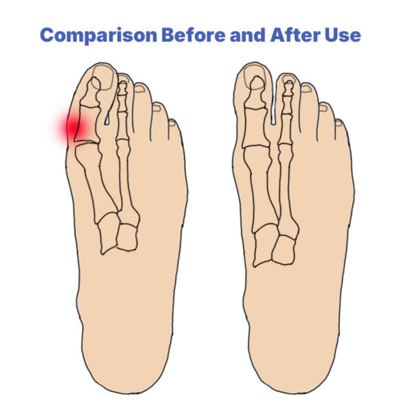 Elastic Tension Band Big Foot Bone Care Bunion Corrector Hallux Valgus Toe Separator